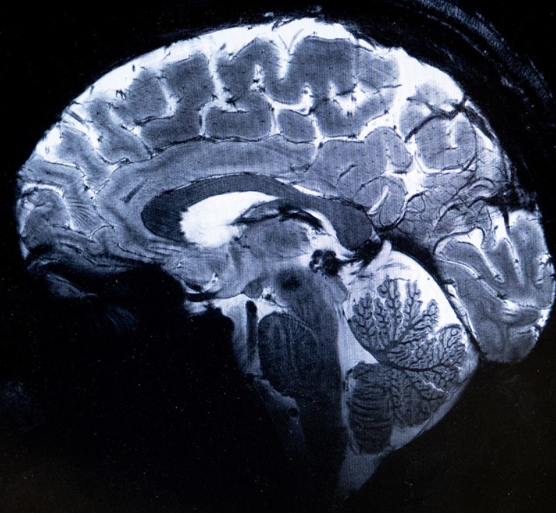 世界上最强大的 MRI 扫描仪的第一张人脑图像核磁共振扫描仪 Iseult 是法国和德国工程师合作二十年的研究成果，其扫描磁场高达 11.7 特斯拉，精度比医院常用的 MRI 机器高 10 倍，可以看到此前看不见的微小血管和小脑细节
