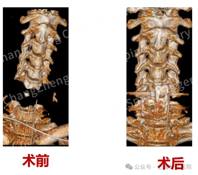 中国医生成功救治"身首离断"患者上海长征医院颈椎外科团队成功救治一名颈椎大跨度离断式脱位患者，这种"身首离断"式损伤在全球极为罕见